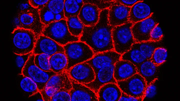 New drug nearly doubles survival rates in some pancreatic cancer patients, study says